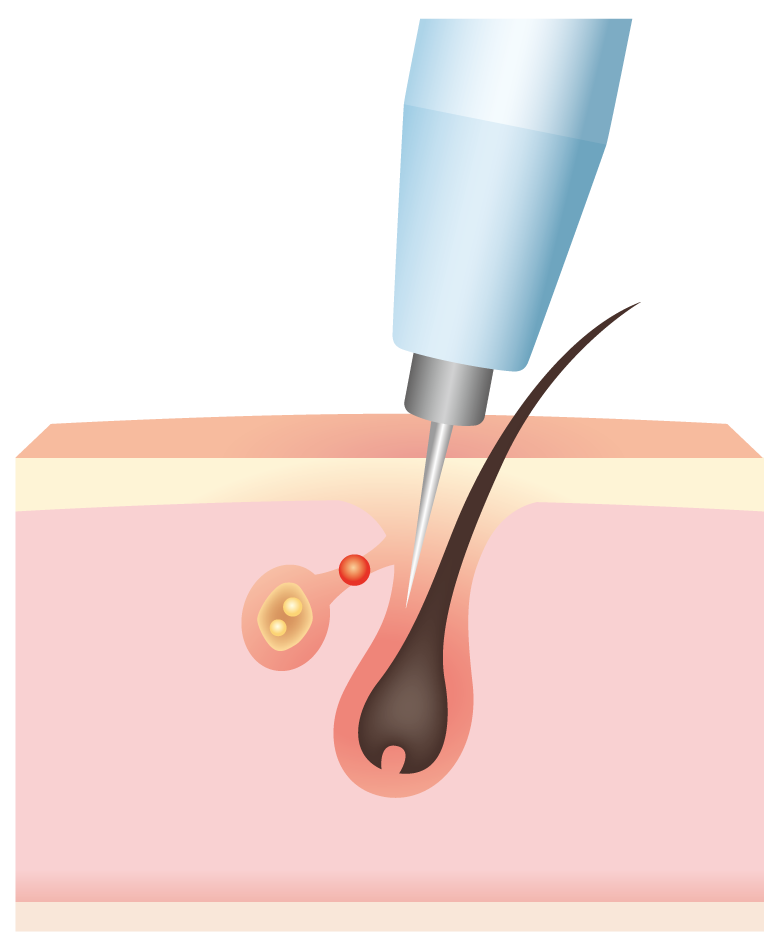 皮脂腺が正常化した状態