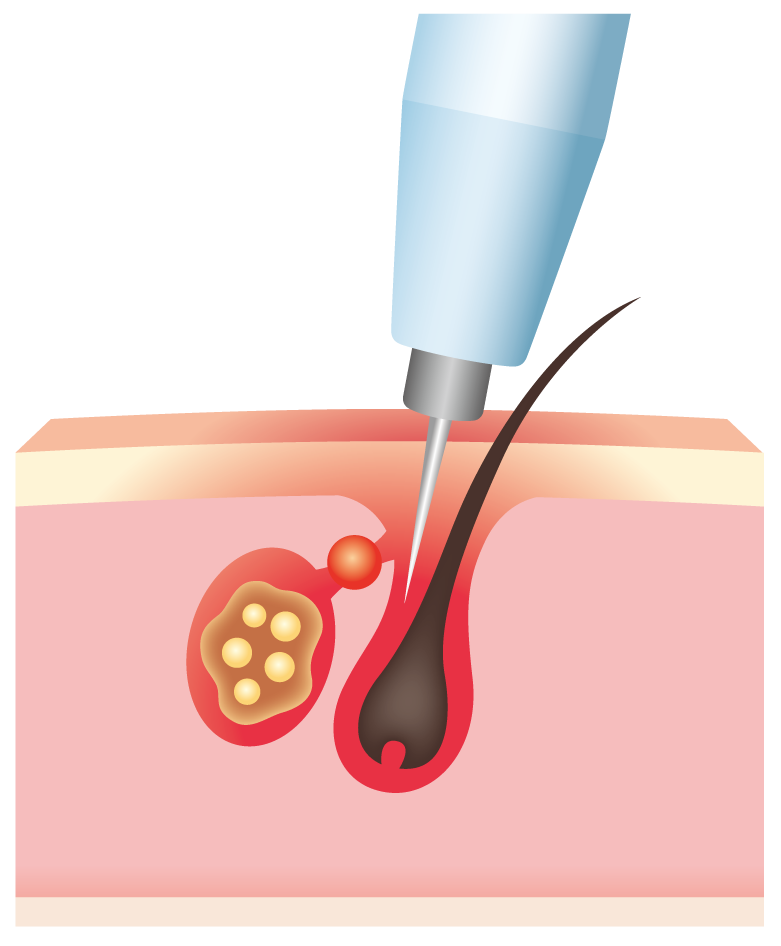針を刺す段階の図
