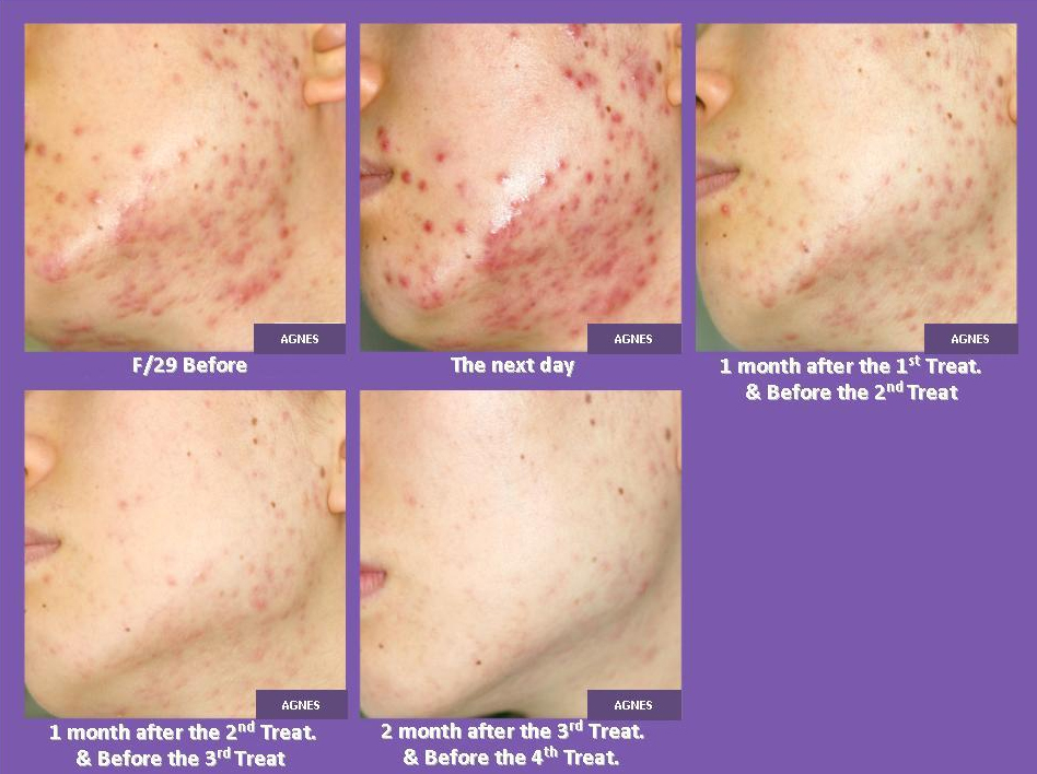 AGNES治療経過（3回）