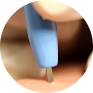 イボ治療（アグネス）の施術