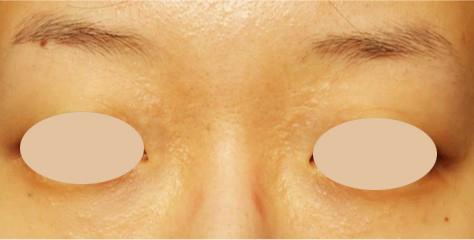 ３ヵ月後（２回）