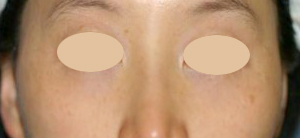 汗管腫の施術後（アグネス）