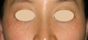 汗管腫の施術前（アグネス）