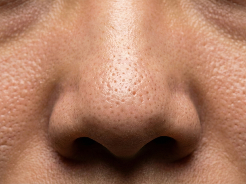 目元の白いブツブツ・稗粒腫・汗管腫などが気になる方