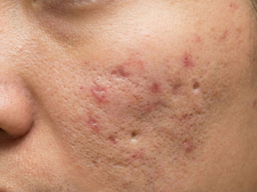 なるべく痛みの少ないニキビ治療が受けたい方