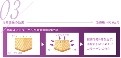 術後の創傷治癒過程で起こるコラーゲン生成により、長期的な効果も期待できる