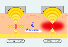 従来のHIFUで行われるドット形式と、新しいリニア形式の両方のメリットを享受できる